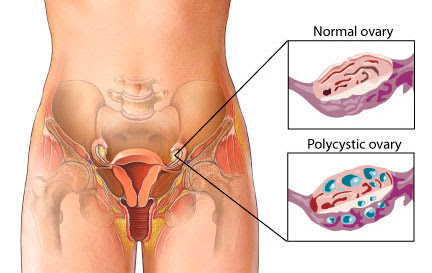 Panchakarma for PCOS